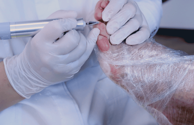 Podologie - Pedichiură medicală