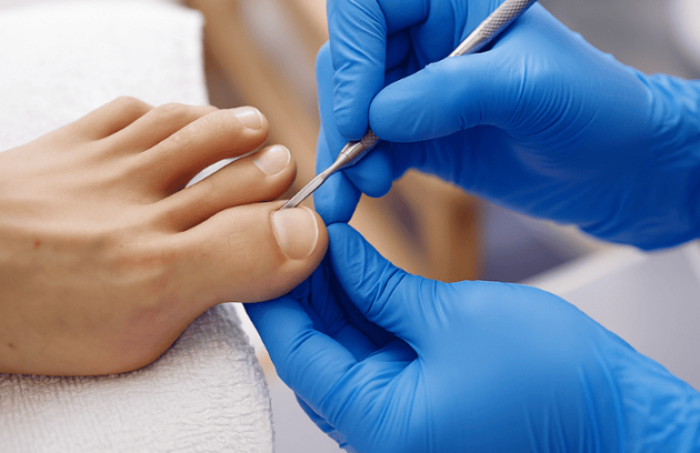 Podologie - Unghii încarnate
